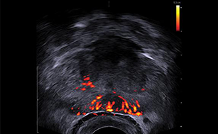 urologie prostata